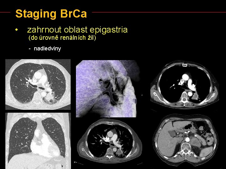 Staging Br. Ca • zahrnout oblast epigastria (do úrovně renálních žil) - nadledviny 