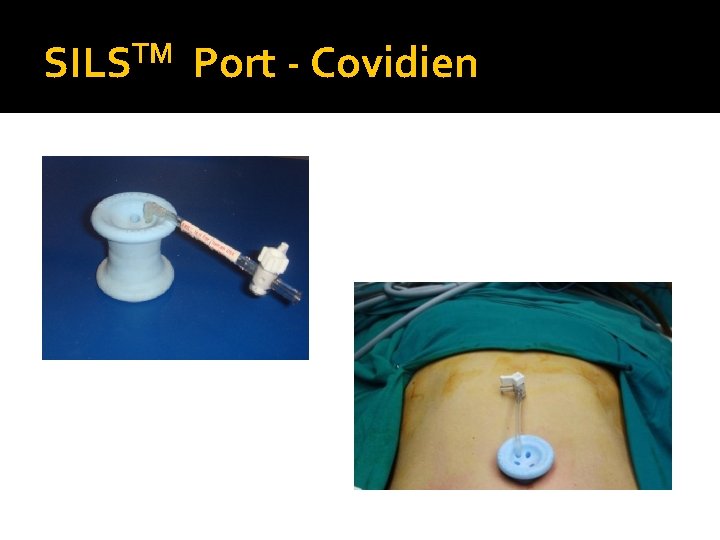 TM SILS Port - Covidien 