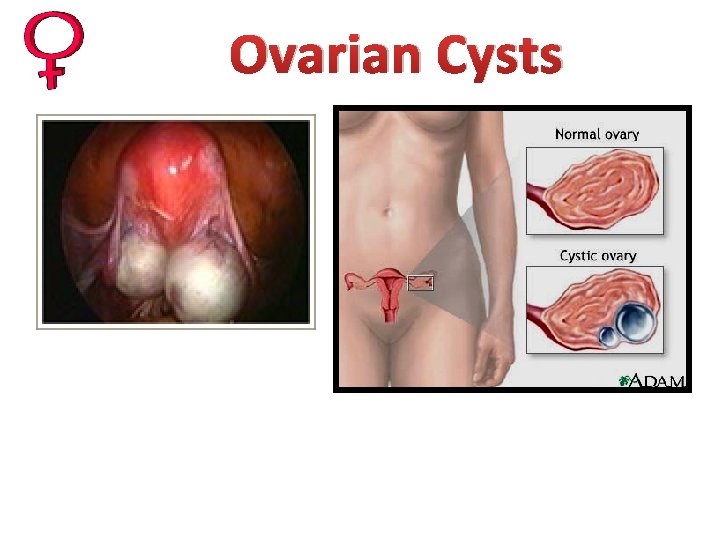 Ovarian Cysts 