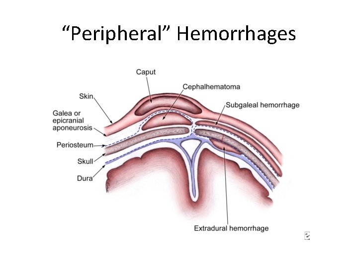 “Peripheral” Hemorrhages 
