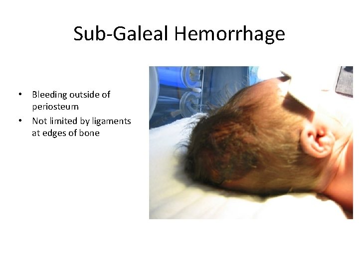 Sub-Galeal Hemorrhage • Bleeding outside of periosteum • Not limited by ligaments at edges