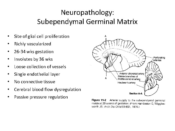 Neuropathology: Subependymal Germinal Matrix • Site of glial cell proliferation • Richly vascularized •