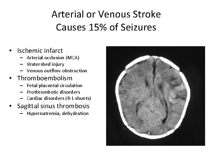Arterial or Venous Stroke Causes 15% of Seizures • Ischemic infarct – Arterial occlusion