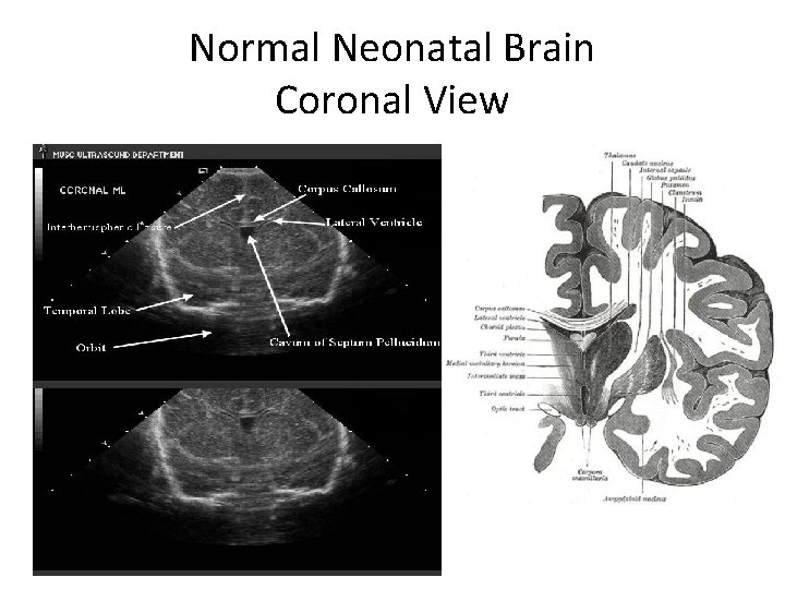 Normal Neonatal Brain Coronal View 
