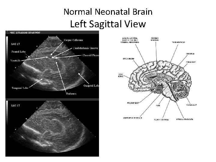 Normal Neonatal Brain Left Sagittal View 