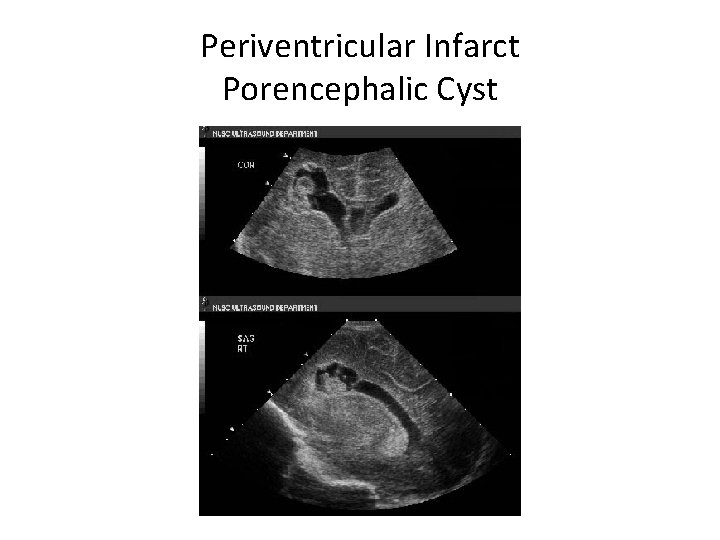 Periventricular Infarct Porencephalic Cyst 