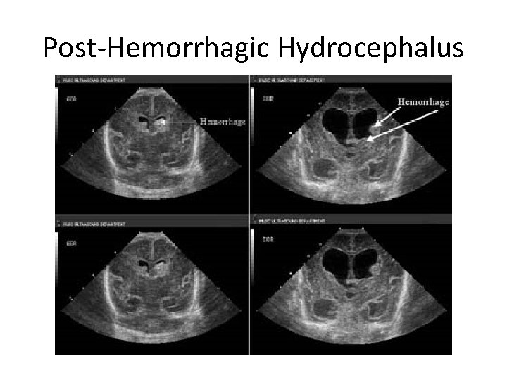 Post-Hemorrhagic Hydrocephalus 