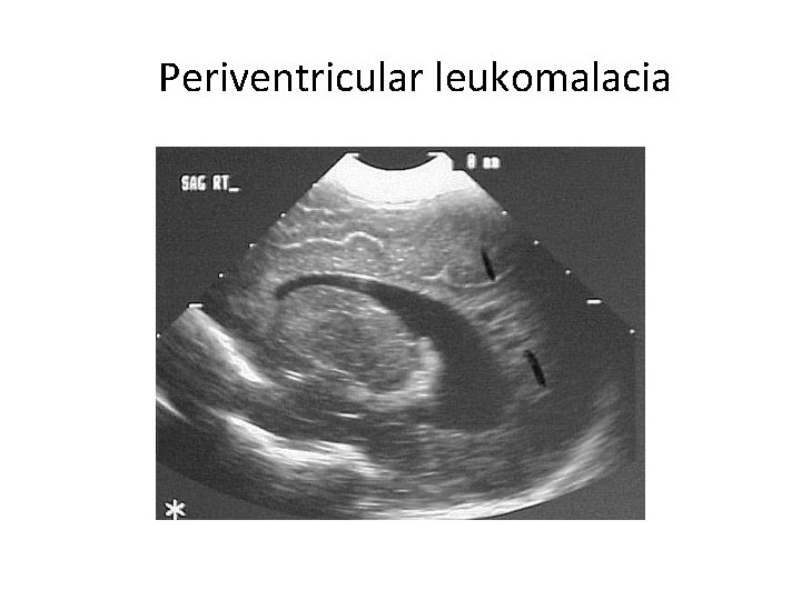Periventricular leukomalacia 