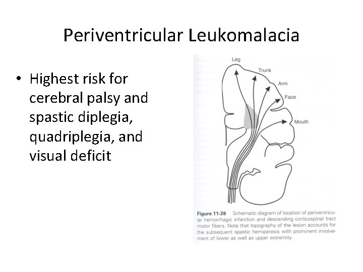 Periventricular Leukomalacia • Highest risk for cerebral palsy and spastic diplegia, quadriplegia, and visual
