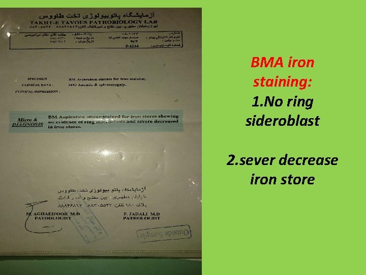 BMA iron staining: 1. No ring sideroblast 2. sever decrease iron store 