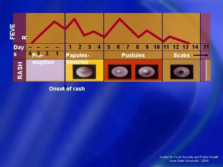 R FEVE RASH Day – – 4 Pre 3 2 1 s eruption 1
