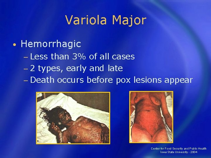 Variola Major • Hemorrhagic − Less than 3% of all cases − 2 types,