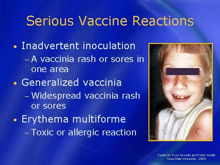 Serious Vaccine Reactions • Inadvertent inoculation −A vaccinia rash or sores in one area