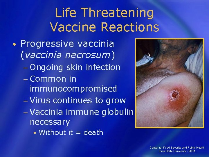 Life Threatening Vaccine Reactions • Progressive vaccinia (vaccinia necrosum) − Ongoing skin infection −