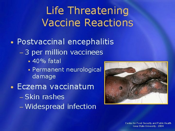 Life Threatening Vaccine Reactions • Postvaccinal encephalitis − 3 per million vaccinees 40% fatal
