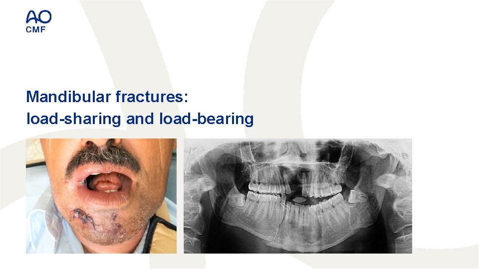 Mandibular fractures: load-sharing and load-bearing 
