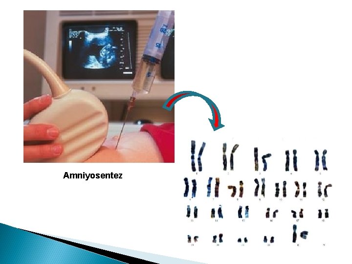 Amniyosentez Amniyosentez
