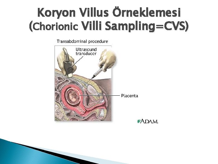 Koryon Villus Örneklemesi (Chorionic Villi Sampling=CVS) 