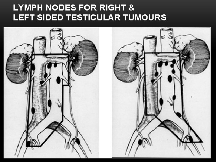 LYMPH NODES FOR RIGHT & LEFT SIDED TESTICULAR TUMOURS 