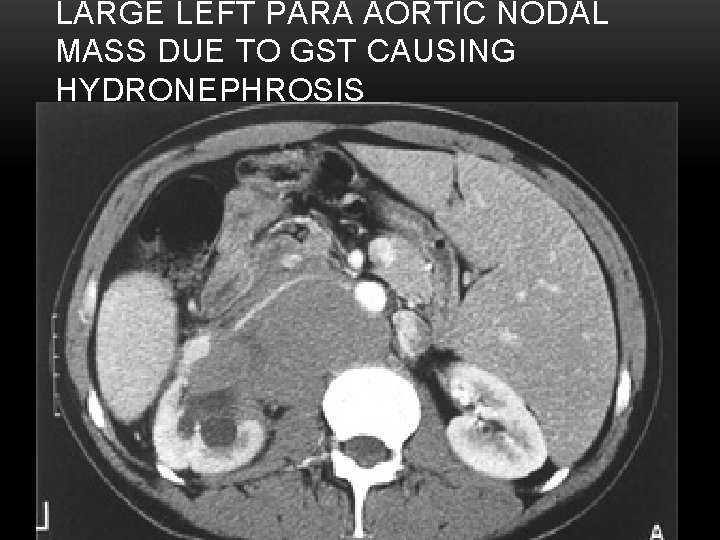 LARGE LEFT PARA AORTIC NODAL MASS DUE TO GST CAUSING HYDRONEPHROSIS 