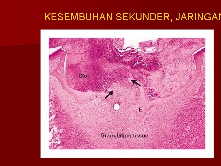 KESEMBUHAN SEKUNDER, JARINGAN 