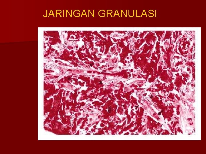 JARINGAN GRANULASI 