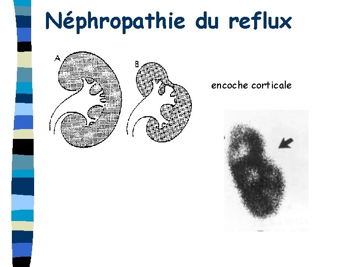 Néphropathie du reflux encoche corticale 
