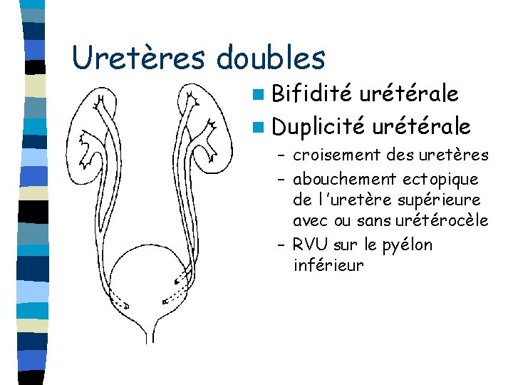 Uretères doubles n Bifidité urétérale n Duplicité urétérale – croisement des uretères – abouchement