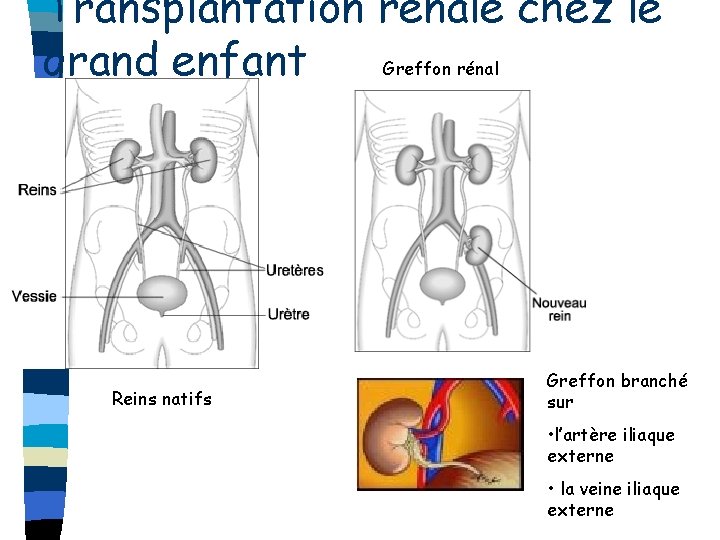 Transplantation rénale chez le Greffon rénal grand enfant Reins natifs Greffon branché sur •