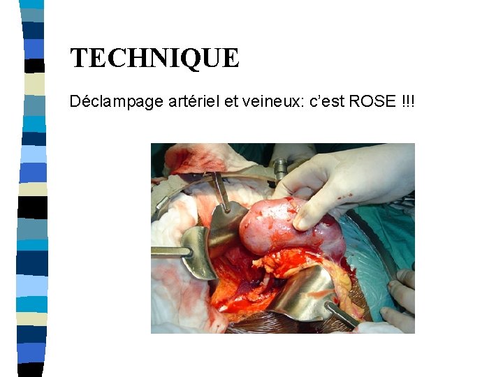 TECHNIQUE Déclampage artériel et veineux: c’est ROSE !!! 