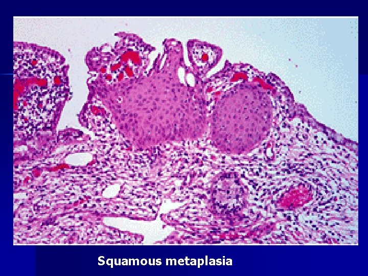 Squamous metaplasia 