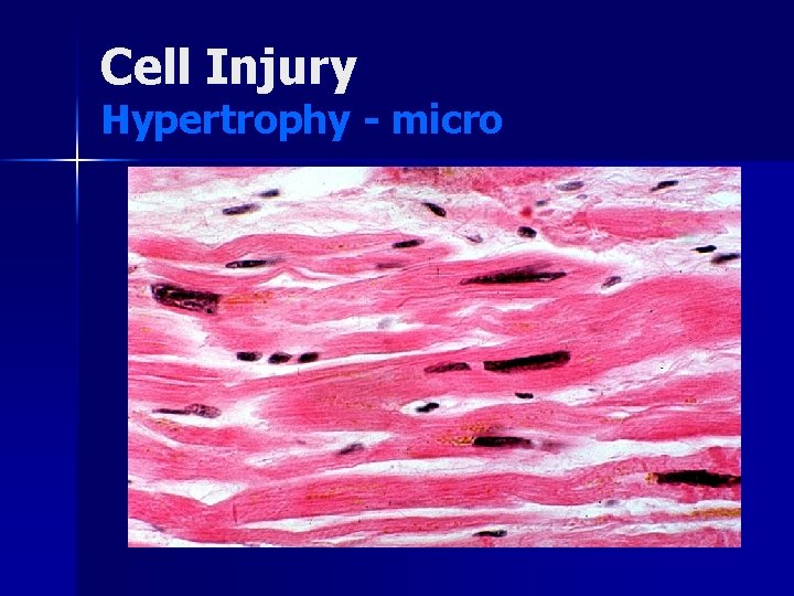 Cell Injury Hypertrophy - micro 