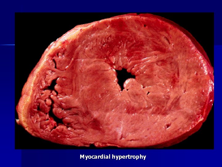 Myocardial hypertrophy 