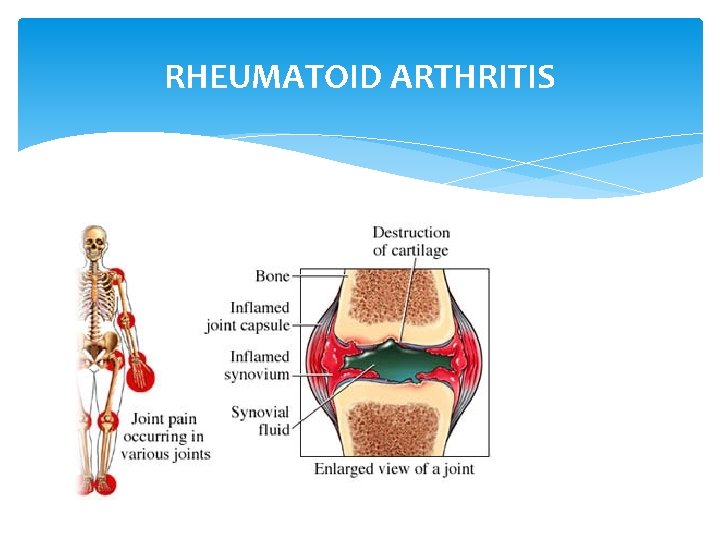 RHEUMATOID ARTHRITIS 