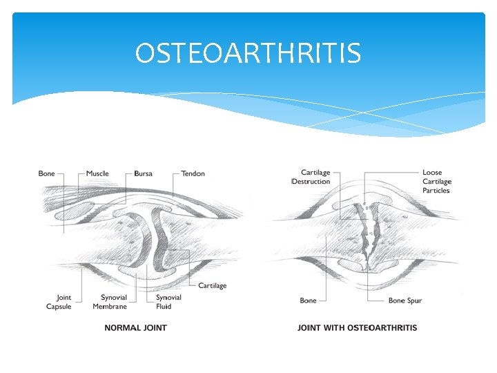 OSTEOARTHRITIS 