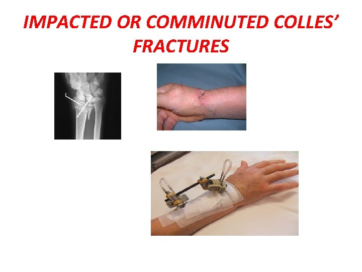 IMPACTED OR COMMINUTED COLLES’ FRACTURES 