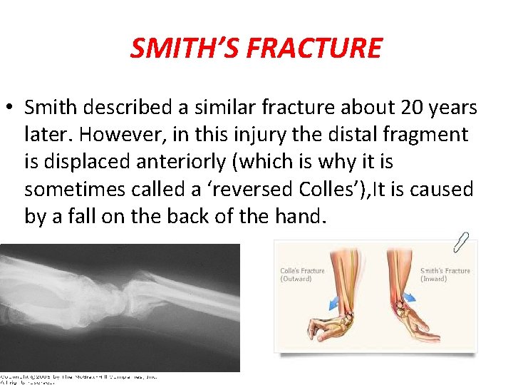 SMITH’S FRACTURE • Smith described a similar fracture about 20 years later. However, in