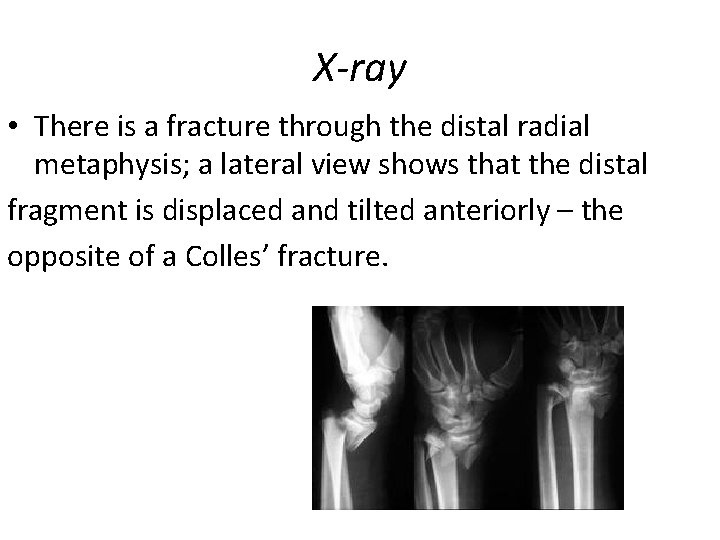 X-ray • There is a fracture through the distal radial metaphysis; a lateral view