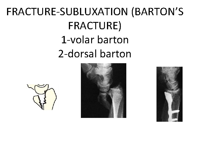 FRACTURE-SUBLUXATION (BARTON’S FRACTURE) 1 -volar barton 2 -dorsal barton 