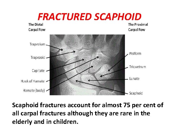 FRACTURED SCAPHOID Scaphoid fractures account for almost 75 per cent of all carpal fractures