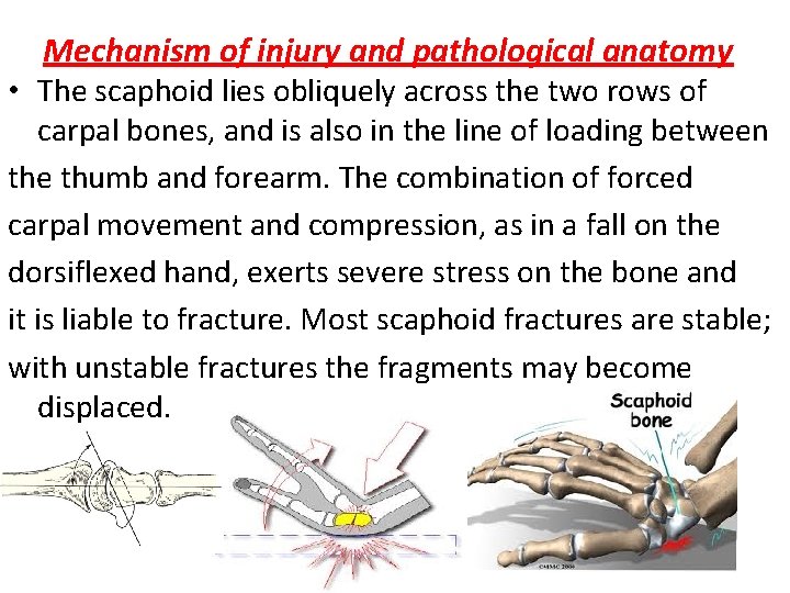 Mechanism of injury and pathological anatomy • The scaphoid lies obliquely across the two