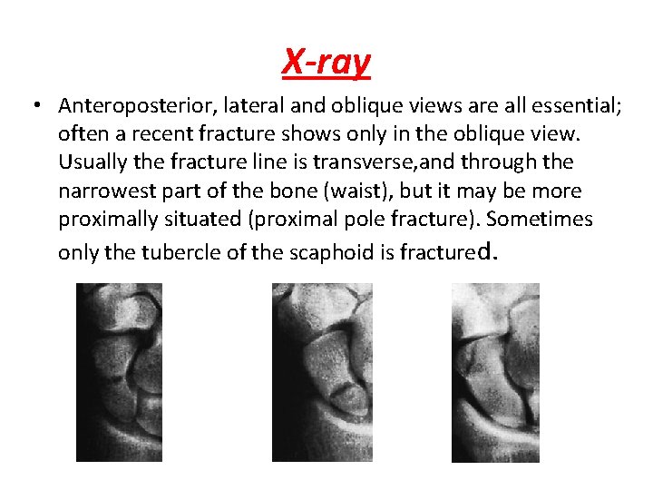 X-ray • Anteroposterior, lateral and oblique views are all essential; often a recent fracture