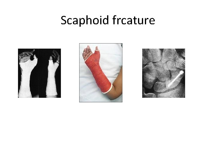 Scaphoid frcature 