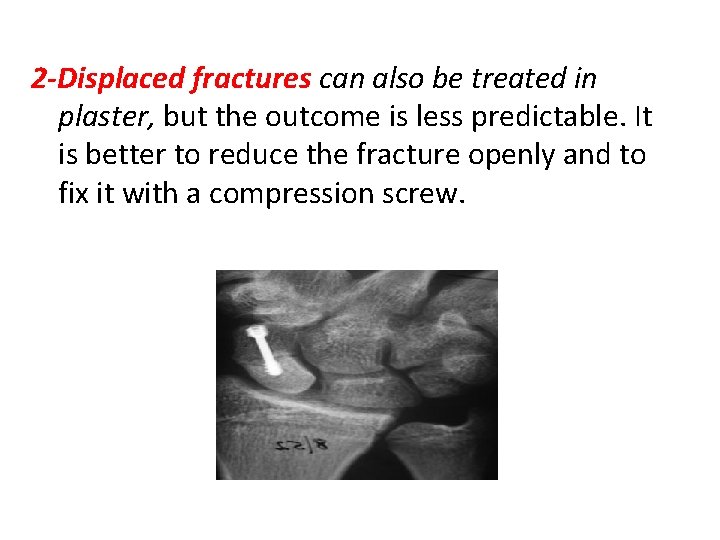 2 -Displaced fractures can also be treated in plaster, but the outcome is less