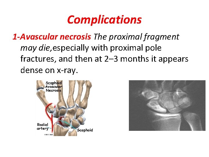 Complications 1 -Avascular necrosis The proximal fragment may die, especially with proximal pole fractures,