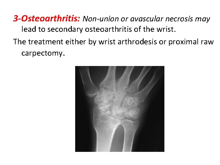 3 -Osteoarthritis: Non-union or avascular necrosis may lead to secondary osteoarthritis of the wrist.