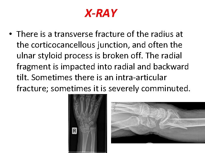 X-RAY • There is a transverse fracture of the radius at the corticocancellous junction,