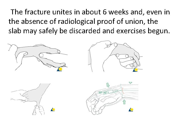 The fracture unites in about 6 weeks and, even in the absence of radiological