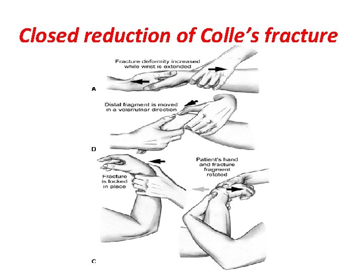 Closed reduction of Colle’s fracture 
