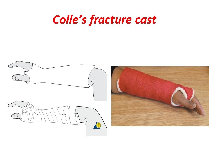 Colle’s fracture cast 